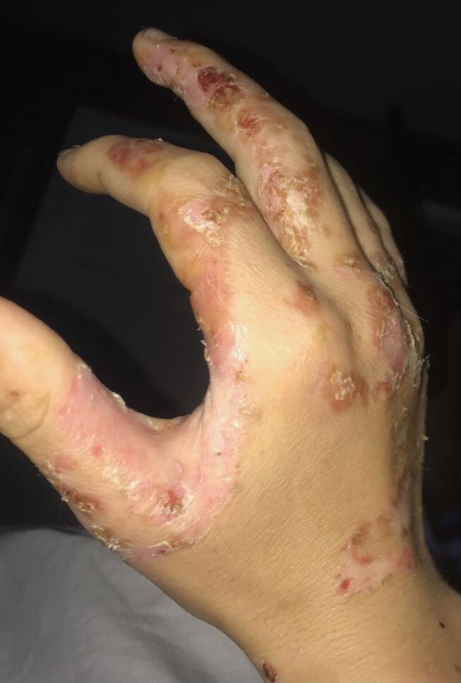 Giant Hogweed burns